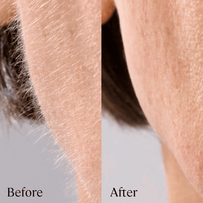 2 Month Supply - Close-up comparison of skin before and after treatment with the Michael Todd Beauty Sonicsmooth Clear Refill Tips, showing a reduction in fine hairs and smoother texture on the "After" side.